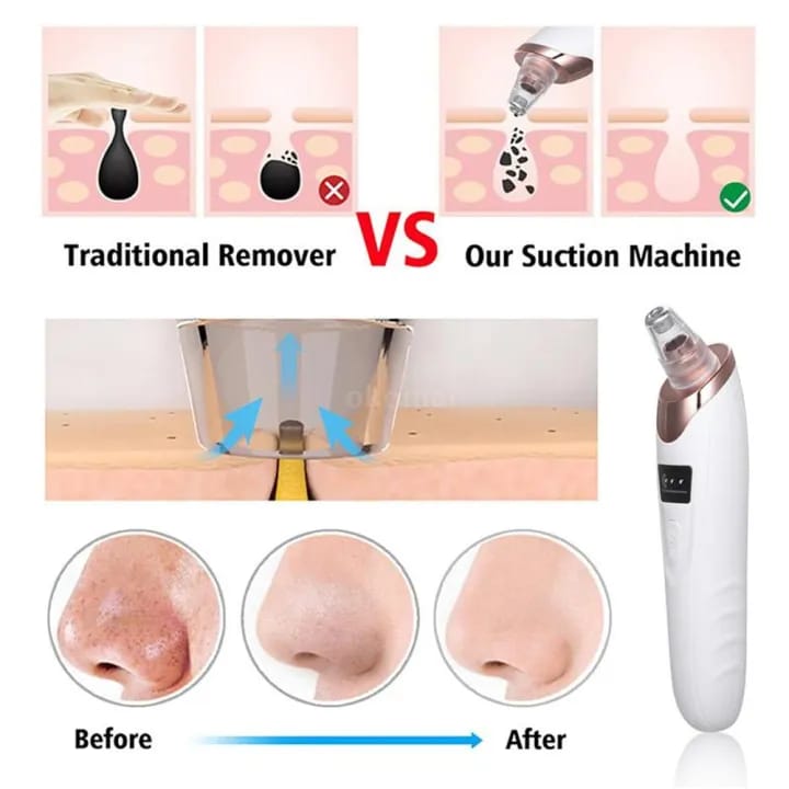 5-in-1 Blackhead Remover – Rechargeable Vacuum Pore Cleaner & Acne Extractor for Skincare